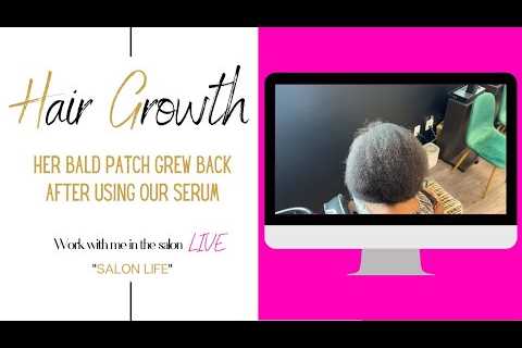 Her bald patch grew back after using our serum |Work with me