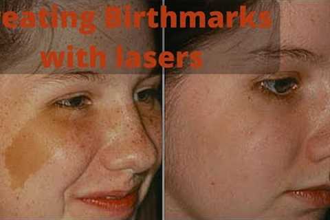 ✨ Birthmark Skin Care | Effective Solutions & Treatment Options 🌟