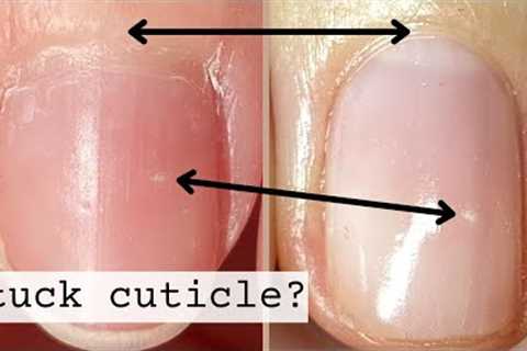 How to Correct Stuck Skin Around The Nails  [3 Week Progress]