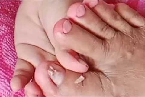 nail technique|Ingrown removal technique|pedicure technique