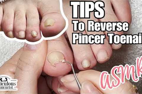 Pincer Toenail Transformation at Home ASMR Relaxing #nails #satisfying